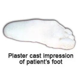 Plaster cast impression of patient's foot